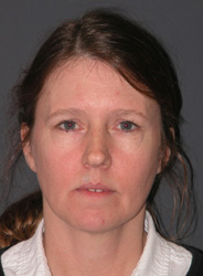 Mid Facelift - Patient 4 - Front - Before